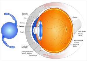 Sponsor an adult cataract surgery with IOL implant @ Rs. 2000/-